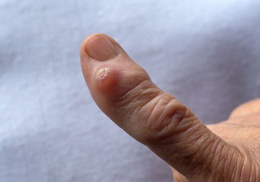An excrescence on the finger of the hand.A wart on my finger.