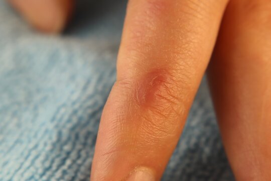 Close-up of a finger showing first degree burn symptoms with mild redness and skin irritation. Ideal for medical education, healthcare awareness, dermatology content, and injury prevention visuals.
