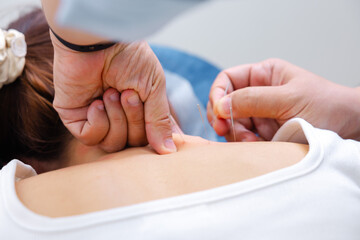 Professional Doctor Doing Acupuncture Therapy on Patient Back for Pain Relief.