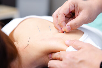 Professional Doctor Doing Acupuncture Therapy on Patient Back for Pain Relief.