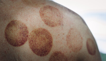 Circular bruises on a back and shoulder after cupping therapy