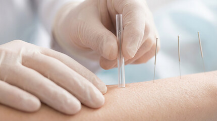 Close-up of professional therapist inserting acupuncture needle into patient skin for medical treatment and pain relief