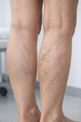 Varicose Veins on Female Legs, Chronic Venous Insufficiency Medical Concept
