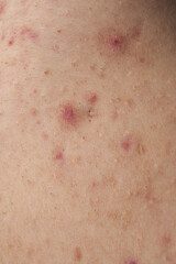 Fototapeta premium Acne on skin closeup. Acne macro pimple on skin. Acne texture in pores. Acne macro for dermatology.