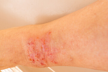 close-up injured female limb with damaged reddened skin, scratches, trophic wound on painful female leg, medical concept, chronic condition, dermatological disorder, skin problem, affected area