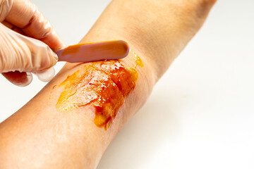 Doctor applying healing ointment to recovering wound on woman leg, treating female ankle, medical treatment skin injury, healthcare support and recovery rehabilitation, patient care, injury healing