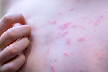 Preteen Child boy with red insect bug bites and rash on skin, scratching irritated skin, expressing mild pain, dermatology, rash treatment, allergic reaction, healthcare problem