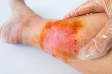 doctor's hands feeling injured female limb with chronic dermatitis, wound on painful female leg, medical concept, dermatological disorder, skin problem, affected area