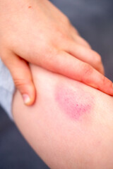 little boy holds sore leg, human skin with large red and prominent purple bruise, showing discoloration from injury, Medical condition, childhood safety