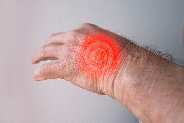 Close-up male hand elderly man with inflamed tendon from rheumatism with visible redness and swelling, hand injuries associated with occupational hazards and need for prevention and treatment
