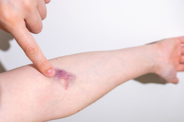 bruise on female hand skin, hematoma on elbow area from blood draw, hurt mark, medical treatment, symptom medical condition, body pain, Health care