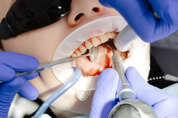 Dentist performing dental checkup cleaning teeth of patient wearing protective glasses