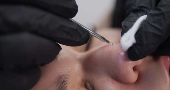 Cosmetic procedures for problematic facial skin in teenagers. Skin cleansing and acne removal.