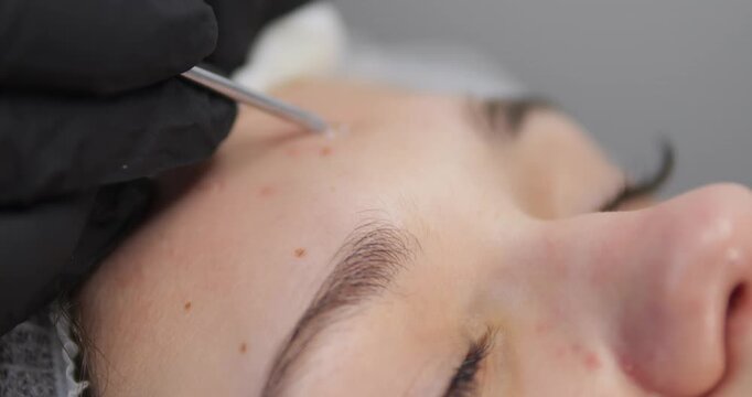 Cosmetic procedures for problematic facial skin in teenagers. Skin cleansing and acne removal.