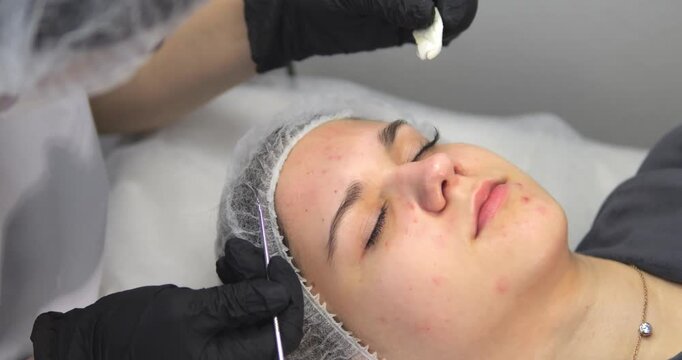 Cosmetic procedures for problematic facial skin in teenagers. Skin cleansing and acne removal.