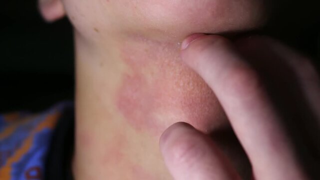 A detailed skin irritation on neck with redness and inflammation close view for medical research
