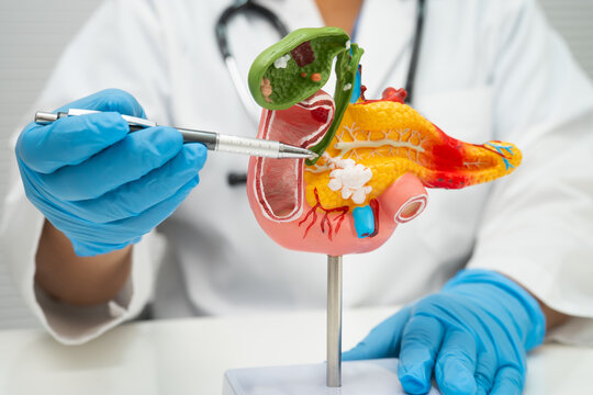 Pancreatitis, pancreatic cancer, Asian doctor with pancreas, gallbladder and bile duct human anatomy model at hospital.