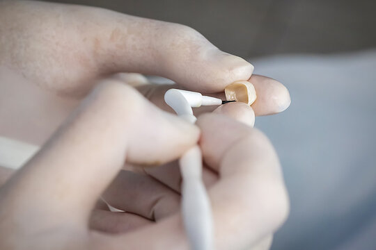 Close-up of silane application on a dental crown before adhesive cementation. Laboratory and clinical dentistry procedure improving bonding strength in modern prosthodontics.