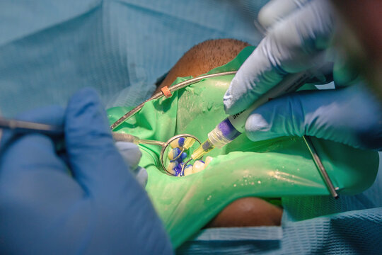 Close-up of dental acid etching under rubber dam isolation. Clinical restorative dentistry procedure preparing tooth surface for strong adhesive bonding.