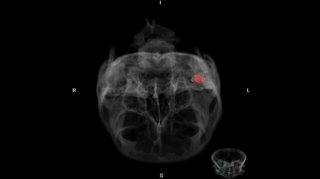 3D CT scan visualization of the mastoid region showing an abnormal tumor mass, highlighting detailed bone anatomy for diagnostic imaging, radiology analysis, and medical education