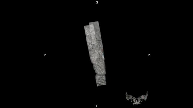 3D CT scan visualization of the mastoid region showing an abnormal tumor mass, highlighting detailed bone anatomy for diagnostic imaging, radiology analysis, and medical education