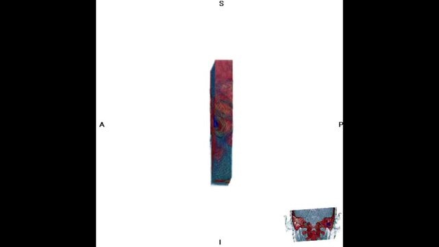 3D CT scan visualization of the mastoid region showing an abnormal tumor mass, highlighting detailed bone anatomy for diagnostic imaging, radiology analysis, and medical education