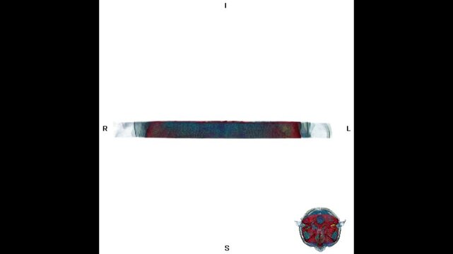 3D CT scan visualization of the mastoid region showing an abnormal tumor mass, highlighting detailed bone anatomy for diagnostic imaging, radiology analysis, and medical education