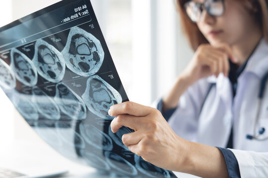 Asian female orthopedics surgeon doctor examining patient's knee joint x-ray films, MRI bone, ct scan in radiology orthopedic unit in hospital. knee joint film x-ray, close up