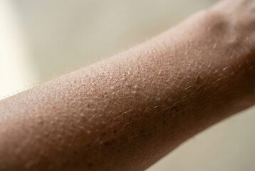 Macro close-up of human skin with goosebumps showing hair follicles reacting to cold or emotion