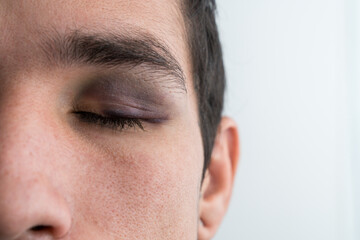Fototapeta premium Man closing eye showing black eye bruising and injury