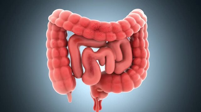 3D Medical Animation of Human Large Intestine Colon with Inflamed Mucosa Progression