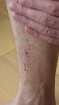 Man scratches itchy lower leg at home, closeup red rash and small wounds show dermatitis allergy, skin irritation problem.