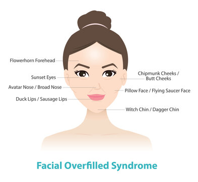 Facial Overfilled Syndrome on woman face vector illustration. Flowerhorn forehead, Sunset eyes, Chipmunk cheeks, Pillow face, Avatar nose, Sausage lips and Witch chin. Medical and beauty concept.