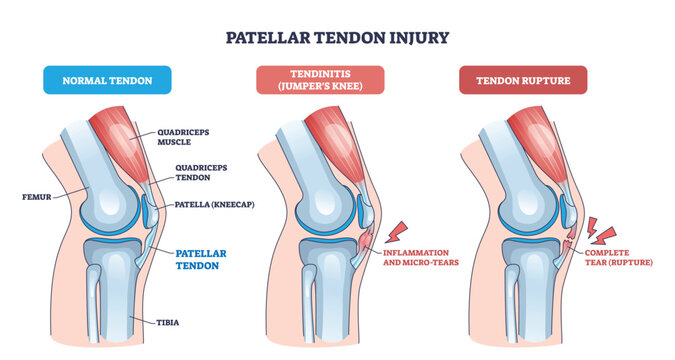 Patellar tendon injury visualizes normal, tendinitis, and rupture, focusing on patella, patellar tendon, and quadriceps to convey knee pain progression. Outline diagram