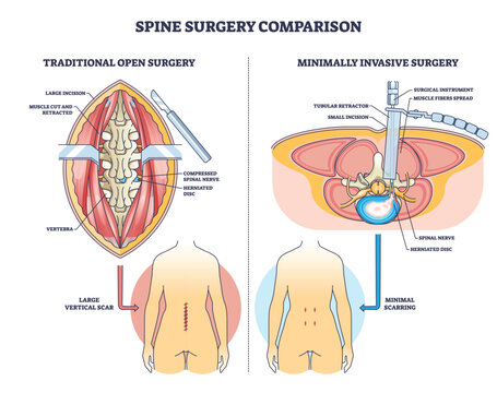 Spine surgery comparison shows open vs minimally invasive methods, highlighting vertebra, herniated disc, and spinal nerve to explain incision and scarring differences. Outline diagram