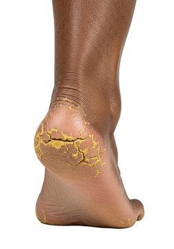 Elderly person's rich dark brown foot sole, extreme close-up showing severe dermatological hyperkeratosis and deeply fissured, flaking dry heel, clinical diagnosis concept