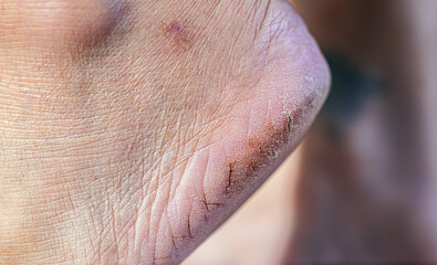 Naklejka premium Close-up of cracked and dry heels showing damaged skin texture, perfect for foot care, podiatry and skincare related content