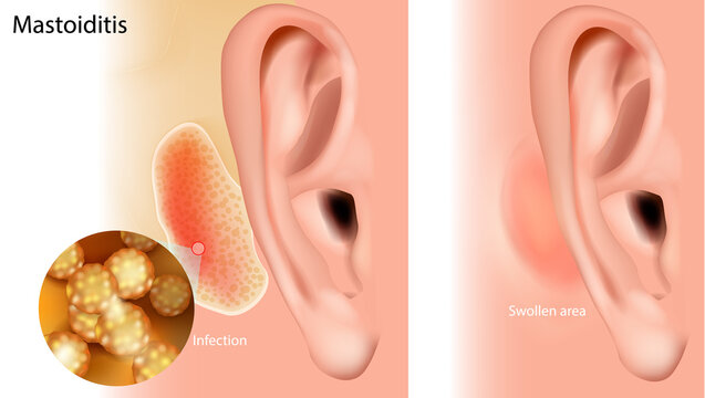 Mastoiditis Medical Illustration of Ear Infection and Mastoid Bone Inflammation. Mastoiditis Inflammation and Swelling Anatomy Diagram 
