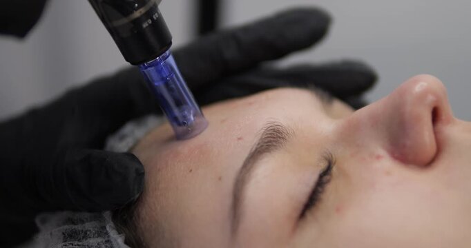 Cosmetic procedure microneedling. Teenage facial skin. Teenage facial skin care. Application of cosmetics and preparations.