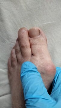 Doctor in blue gloves examining hallux valgus bunion on patient's foot