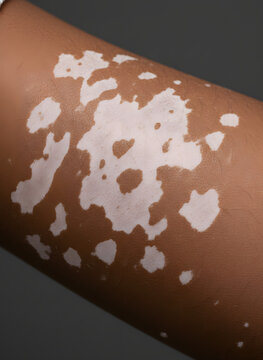 Close-up of hypopigmented patches on the arm, characteristic of Tinea Versicolor