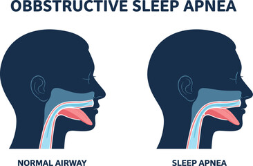 Medical comparison of normal airway and obstructive sleep apnea condition, breathing issue anatomy diagram, flat vector illustration