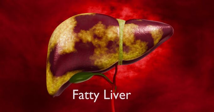 Liver Disease Progression Showing Five Stages from Healthy Liver Fatty Liver Fibrosis Cirrhosis to Liver Cancer for Medical Education and Health Awareness 3D Rendering
