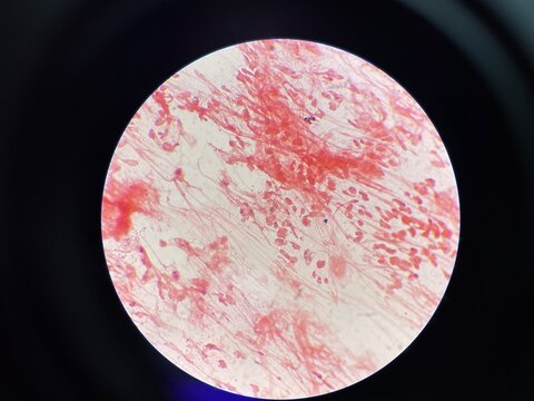 Gram negative diplococci sample pus from penis.
