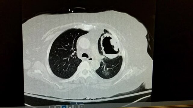 CT Chest - vasculitis with cavitary pneumonia and lung abscess