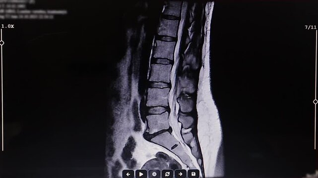Axial CT scan showing bipolar disc herniation with anterior and posterior extension in the lumbar sacral spine, ideal for medical education, radiology reference, diagnosis, and healthcare content.
