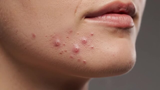 Close-up of human face with acne on jawline, lips visible