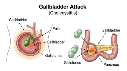 Medical of gallbladder attack with gallstones and pain points cholecystitis