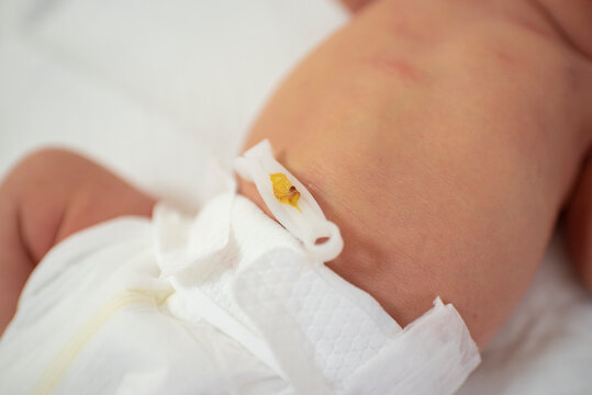 baby's belly, a disposable sterile umbilical clamp on the navel, the baby is 1 day old.