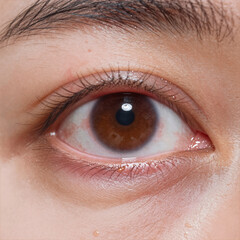 Obraz premium Close-up view of red, watery eye with conjunctivitis/pink eye symptoms